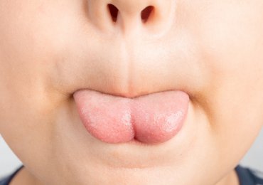 Troubles des fonctions oro-myo-faciales